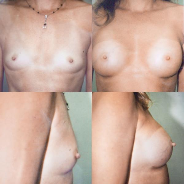 Case #12: 34 years old, 5’4", 120 pounds. 240cc. anatomical textured saline subpectoral implants, inframammary incision at 8 weeks post-operatively.