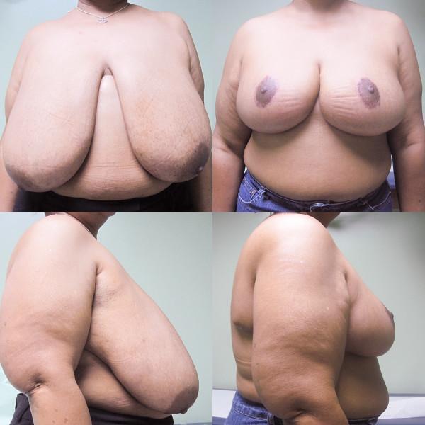 Case #3: 180 pounds, 5'3". 1237 grams removed from right, 1046 grams from left breast. Note: No vertical scar with this breast reduction. Post-operative photos at 3 months.