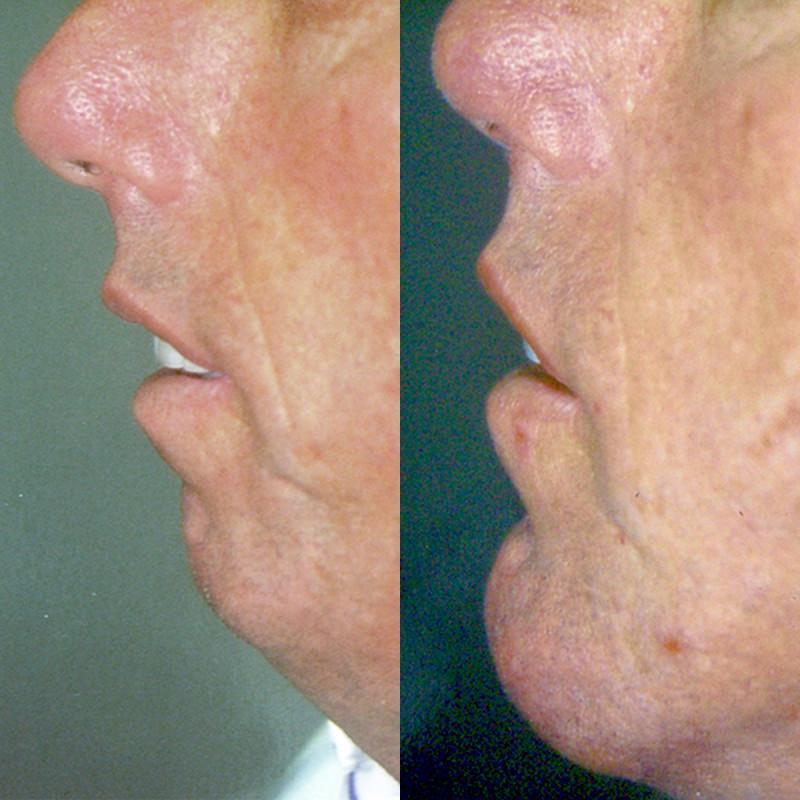 Case #1: Patient has a small chin preoperatively. Implant mentoplasty postoperative photo taken at 1 year.