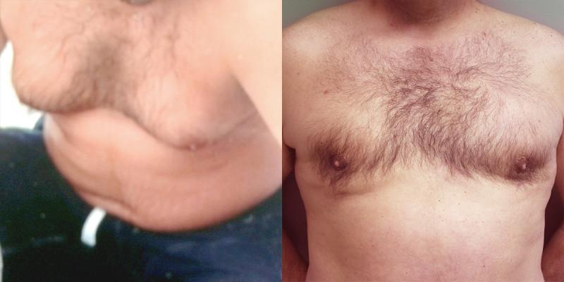 Case #2: Preoperative photo on the left. Postoperative photo at 6 months.