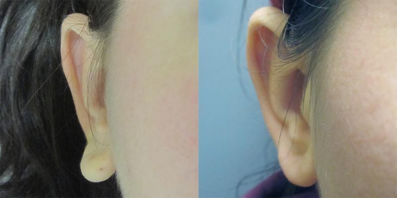 Case #6: This earlobe was twisted out since birth. Post-operative photo at 6 months.