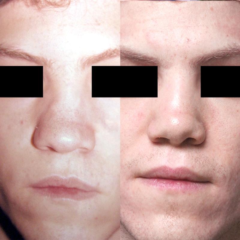Case #2: Cosmetic Rhinoplasty to treat a crooked nose. Post operative photos at 2 years.