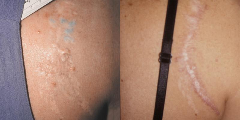 Case #1: Many laser treatments had failed to remove this tattoo. Post-excision photo at 6 months.