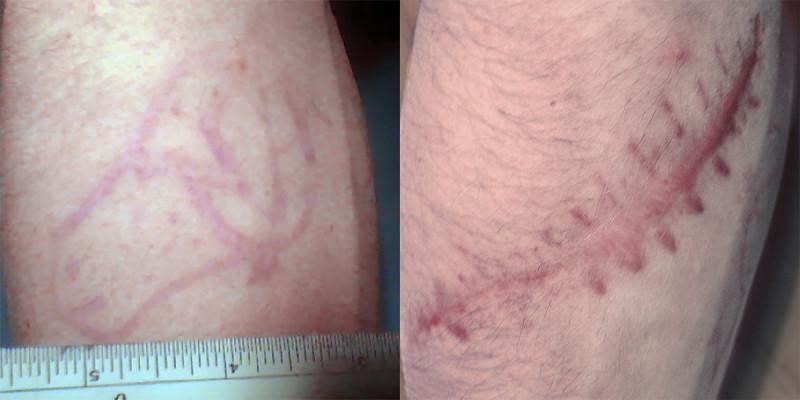 Case #3: Multiple laser treatments failed to remove this tattoo. Post-excision photo at 6 months.