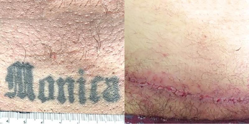 Case #4: Post-op photo at 2 weeks: this scar will continue to fade away.