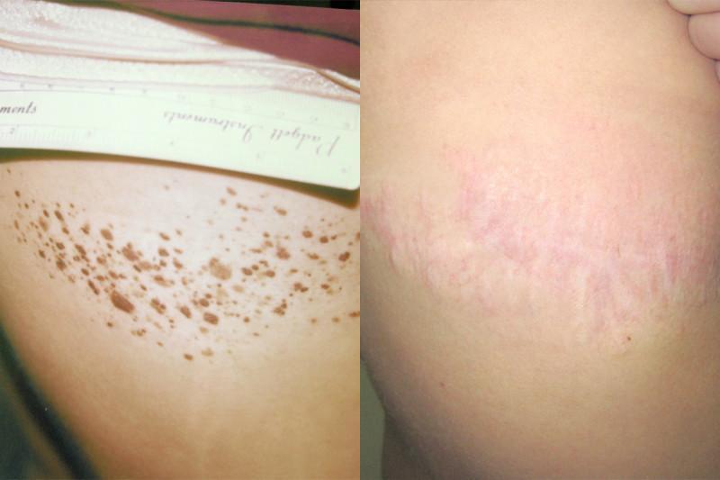 Case #3: Diffuse constellation nevi on a young girl's right back. Post-op photo at 16 months.