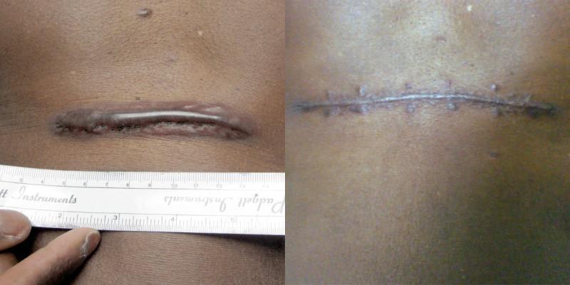 Case #1: Keloid treated with excision & steroid injections. Post-op photo at 4 months.