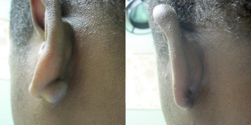 Case #2: Ear piercing keloid treated with excision & steroid injections. Post-op photo at 2 months.