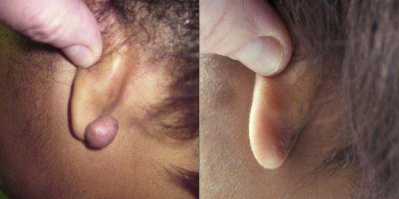 Case #3: Ear piercing keloid treated with excision & steroid injections. Post-op photo at 2 months.