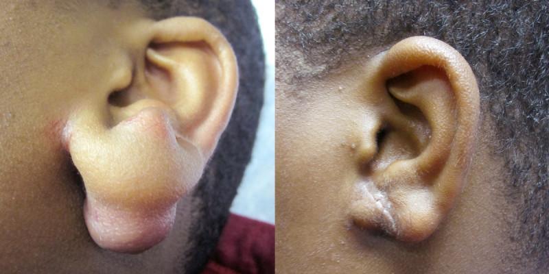 Case #4: Keloid from ear piercing pictured 4 months after excision, radiation, steroids & compression ear ring.