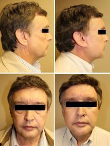 Case #20: Face lift, neck lift, blepharoplasties and chin augmentation. Postoperative photographs at 6 months