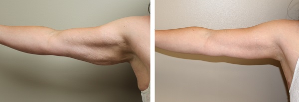 Arm lift and brachioplasty in Chicago and Elmhurst - Krochmal Plastic  Surgery