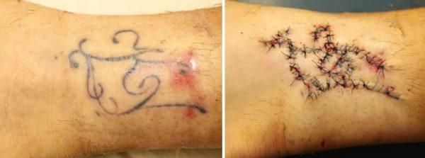 Case #12: Ankle tattoo with persistent pigment after 12 failed PicoSure® laser treatments. Post-operative photo immediately after surgical resection.